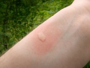 mosquito bite pictures
