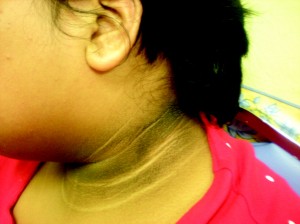 Acanthosis Nigricans in Children