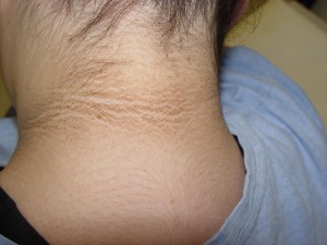photos of Acanthosis Nigricans