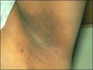 pictures of Acanthosis Nigricans