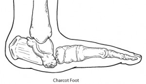 Charcot Foot images