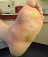 pictures of Charcot Foot