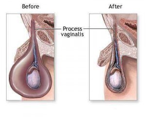 photos of hydrocele