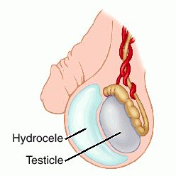 pictures of hydrocele