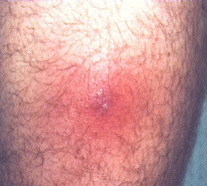 boils on inner thigh images