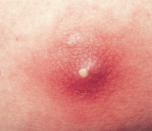 pictures of boils on inner thigh