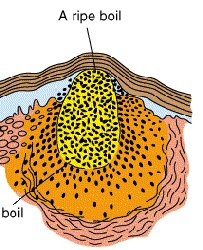 images of Boils