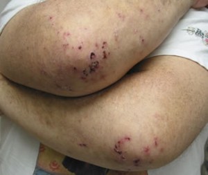 Dermatitis Herpetiformis Picture