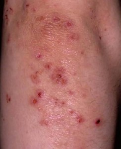 photos of Dermatitis Herpetiformis