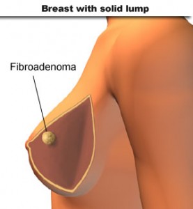 pictures of Fibroadenoma breast