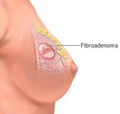 Fibroadenoma images
