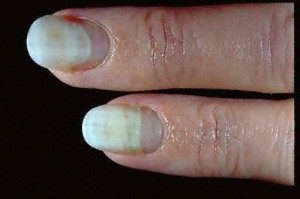 pictures of Onycholysis