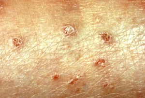 Dermatitis Herpetiformis Photo