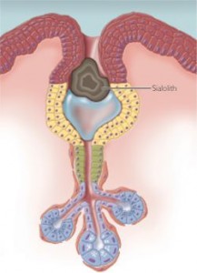 Sialolithiasis Pictures