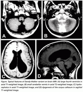 dandy walker syndrome pictures