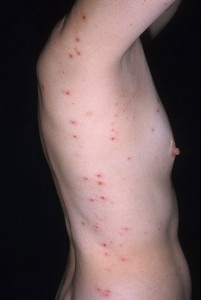 Images of Dermatitis Herpetiformis