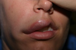 pictures of Angioedema