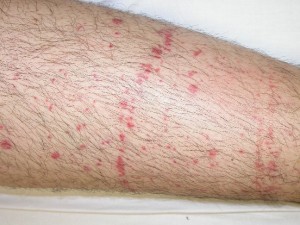 Petechiae rash