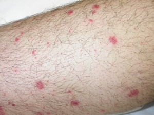 Petechiae rash pictures