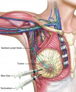 Image of Sentine Lymph Node Biopsy