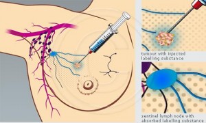 Picture of Sentinel lymph Node