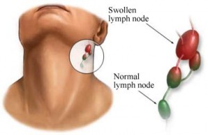 Swollen Lymph Node in Neck Pictures