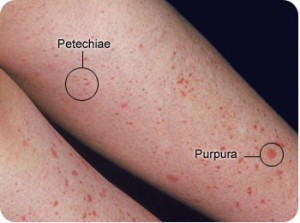 petechiae and purpura picture