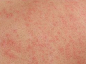 photos of Amoxicillin Rash