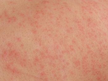 can amoxicillin cause itching without rash