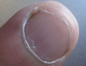 Ingrown Finernail pictures