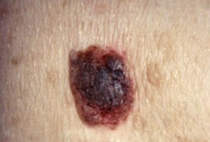 Seborrheic Keratosis picture