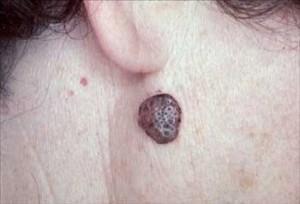 images of Seborrheic Keratosis