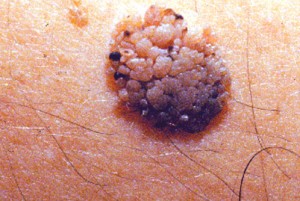 photos of Seborrheic Keratosis