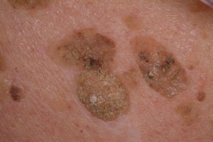 picture of Seborrheic Keratosis