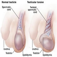 Testicular Torsion Photos