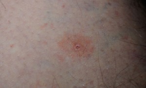 Tick Bite Rash Pictures