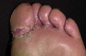 Tinea Pedis Images