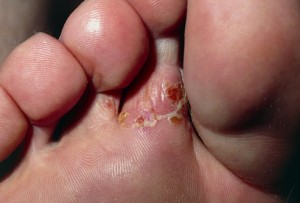 Photos of Tinea Pedis