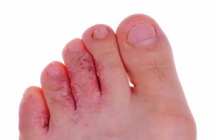 Pictures of Tinea Pedis