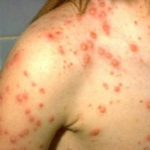 chicken pox pictures