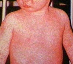 viral rash pictures in children