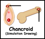 Pictures of Chancroid 