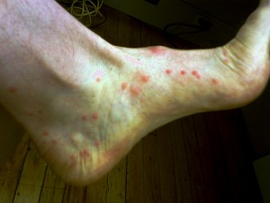 pictures of Flea bites on humans