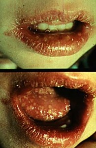 photos of Gingivostomatitis