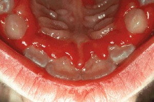 pictures of Gingivostomatitis