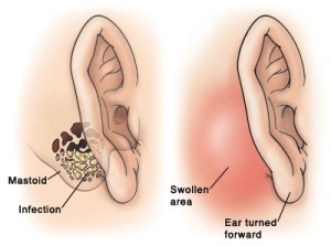 Mastoiditis in adults and its signs