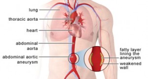 Photos of Aortic Aneurysm