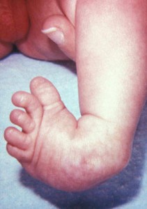 Clubfoot Picture