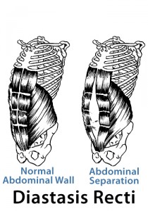 Diastasis Recti images