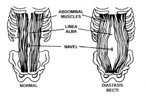 pictures of Diastasis Recti